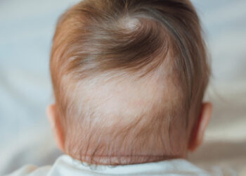 Issues causing infant hair loss