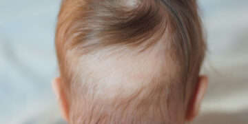 Issues causing infant hair loss