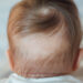 Issues causing infant hair loss