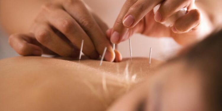 Can Acupuncture Help Pregnant Woman With Lower Back and Pelvic Pain?